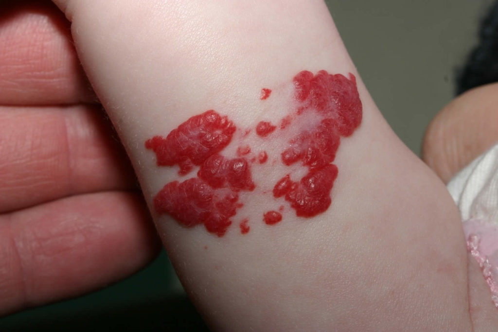 Birthmark causes, types of birthmarks and how to get rid of birthmarks