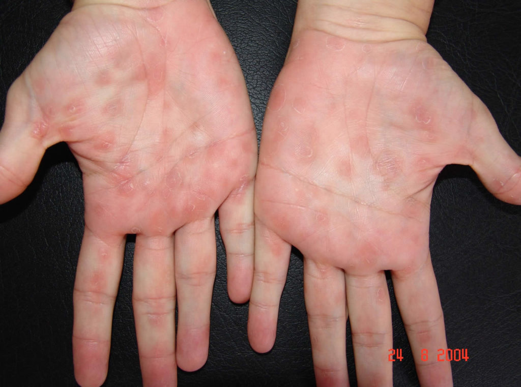 Can You Get Syphilis By Touching Rash at Joesph Phung blog