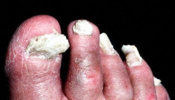 Toe nail fungus infection