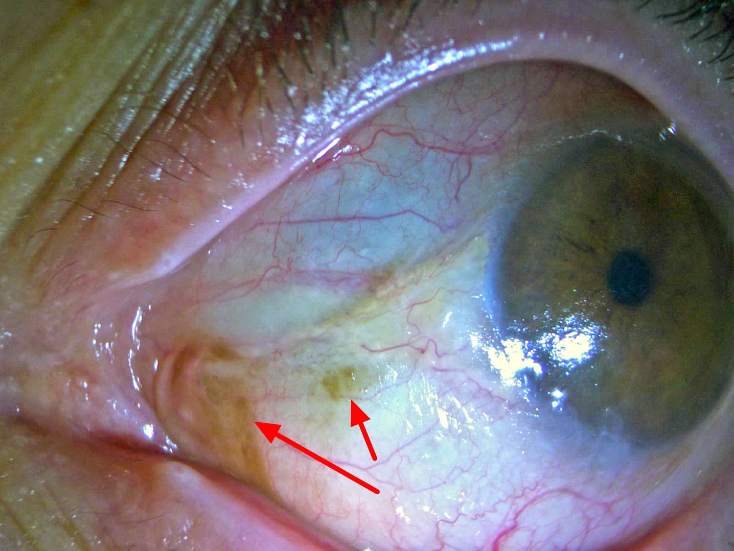Night blindness or nyctalopia causes and night blindness treatment