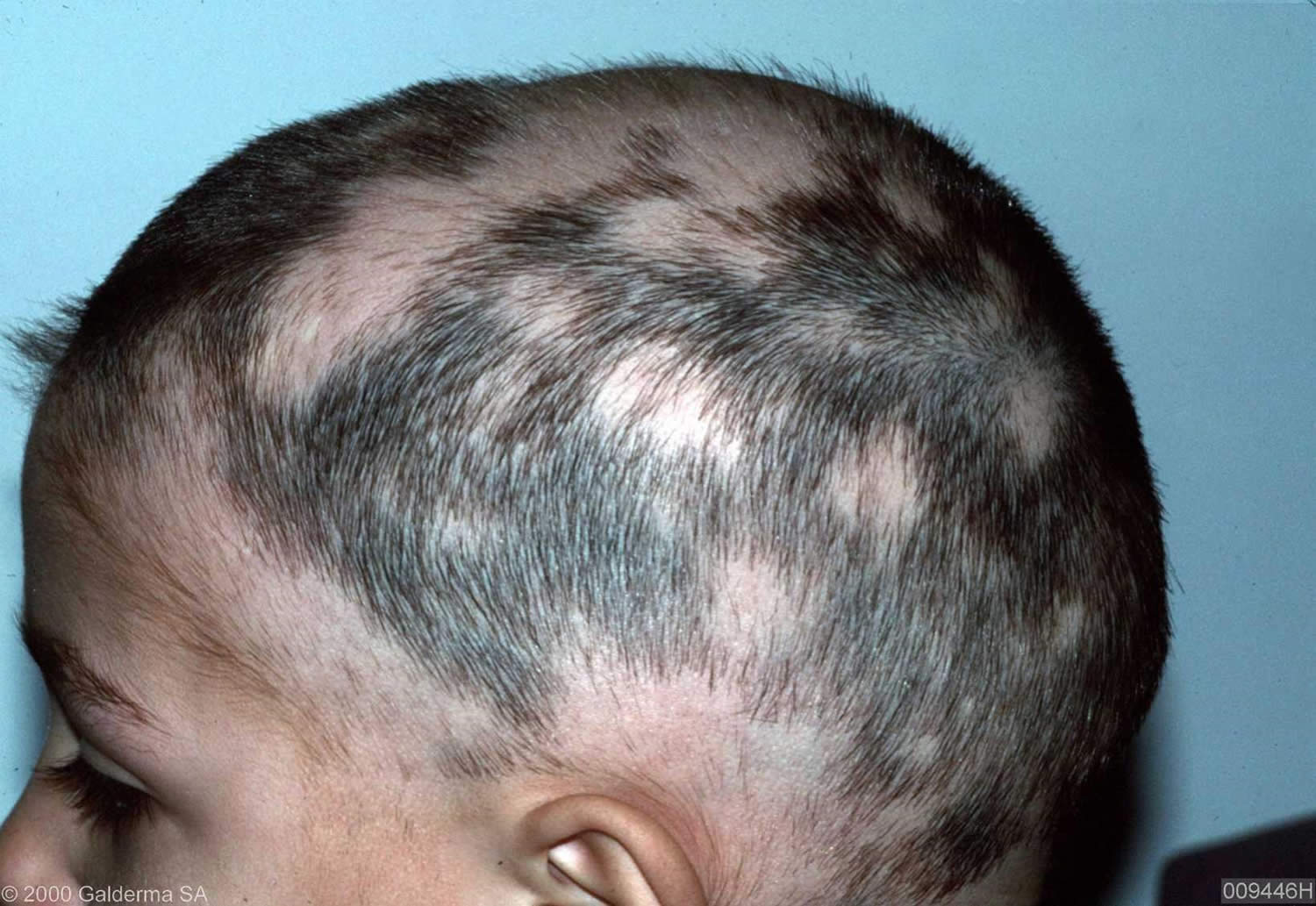 Alopecia areata causes, symptoms and best treatment for alopecia areata