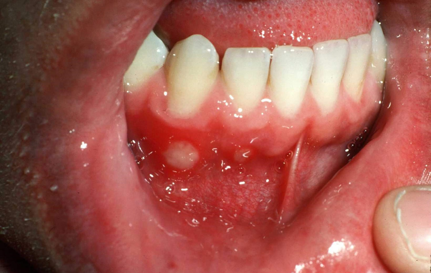 Aphthous Stomatitis Aphthous Ulcer Causes Aphthous Stomatitis Treatment