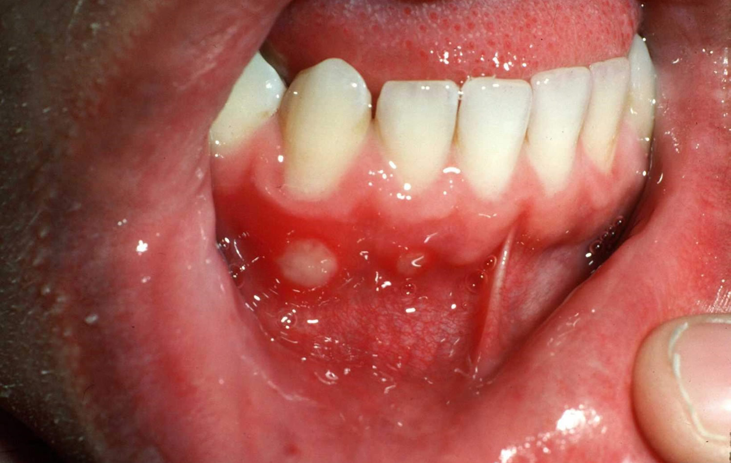 what-is-the-difference-between-cold-sores-and-mouth-ulcers-news