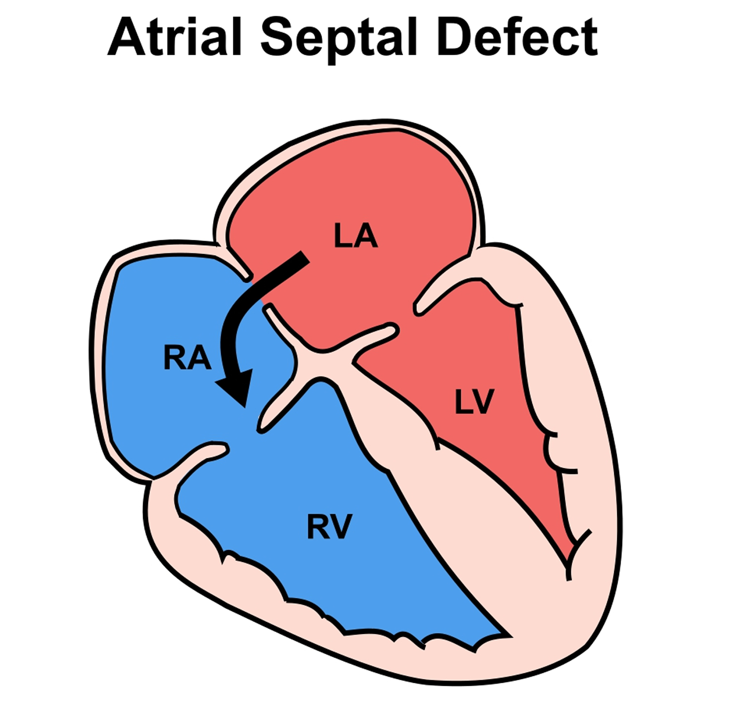 Hole in heart causes, symptoms, prognosis, diagnosis and treatment