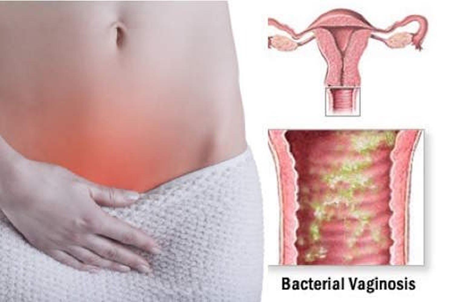 Bacterial Vaginosis Causes Symptoms Diagnosis