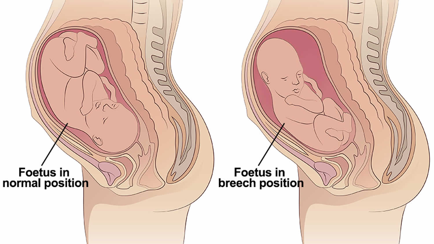 What Is The Opposite Of Breech Position