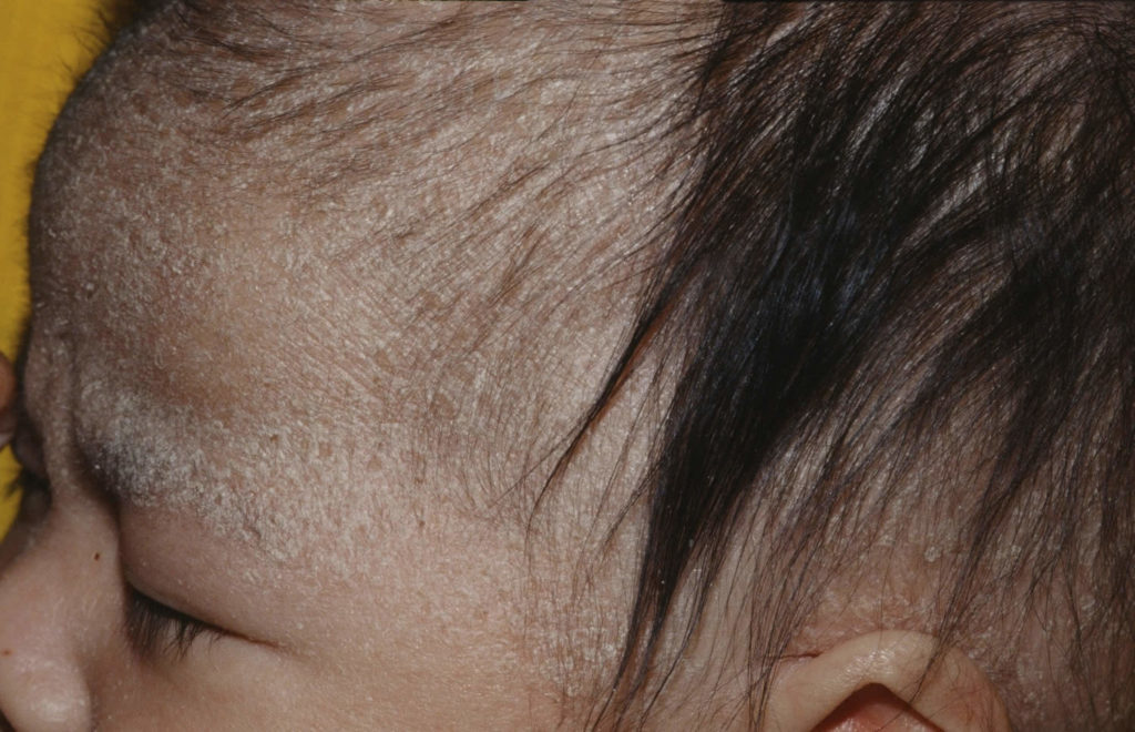 Cradle cap, causes, symptoms, diagnosis, treatment & prognosis