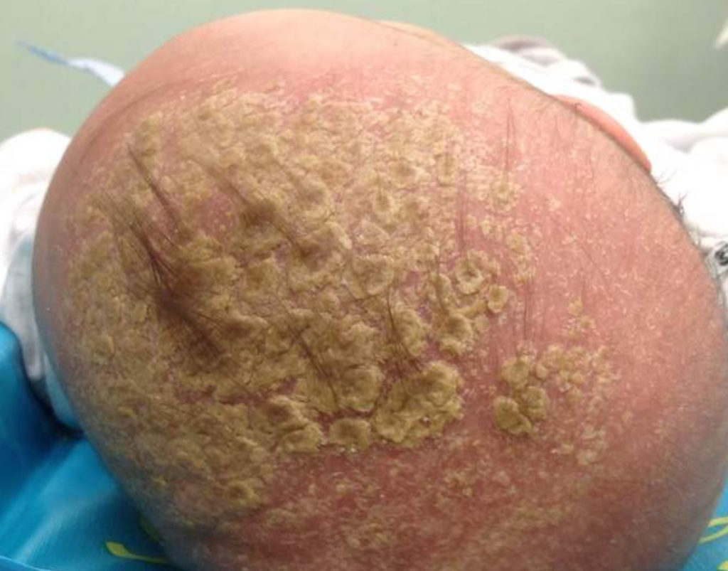 Cradle cap, causes, symptoms, diagnosis, treatment & prognosis