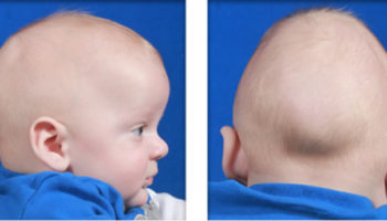 craniosynostosis