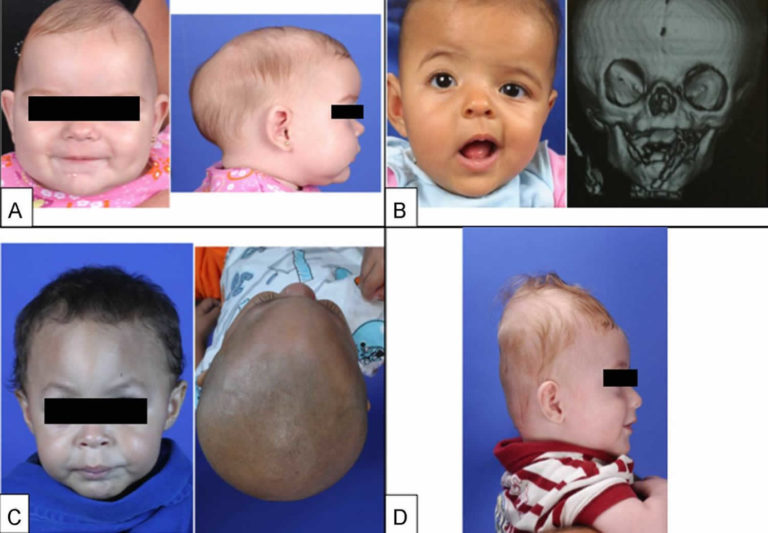 Craniosynostosis Causes, Symptoms, Treatment & Craniosynostosis Surgery