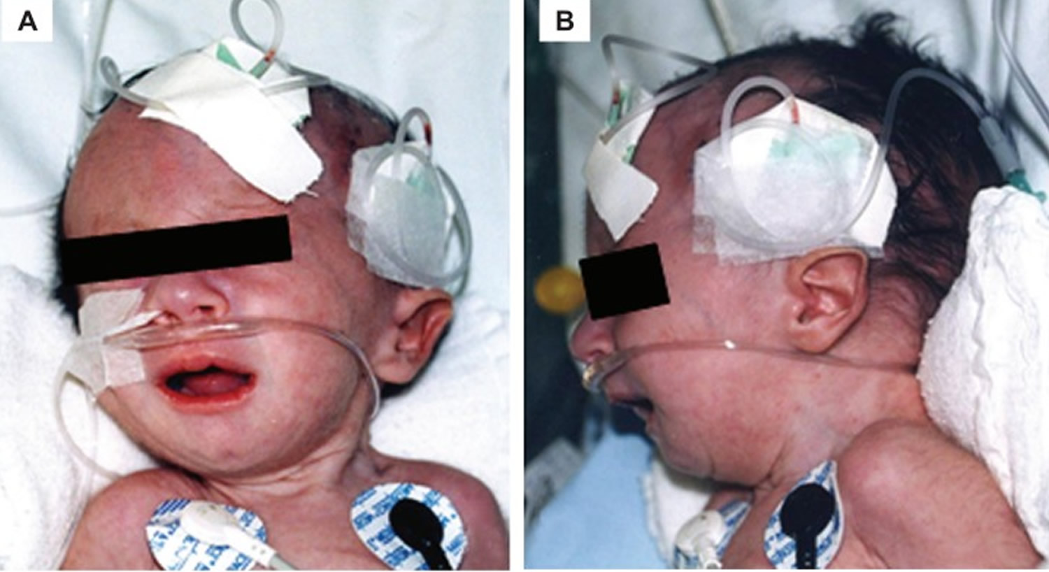 Trisomy 18, Edwards Syndrome Causes, Symptoms, Life Expectancy & Treatment