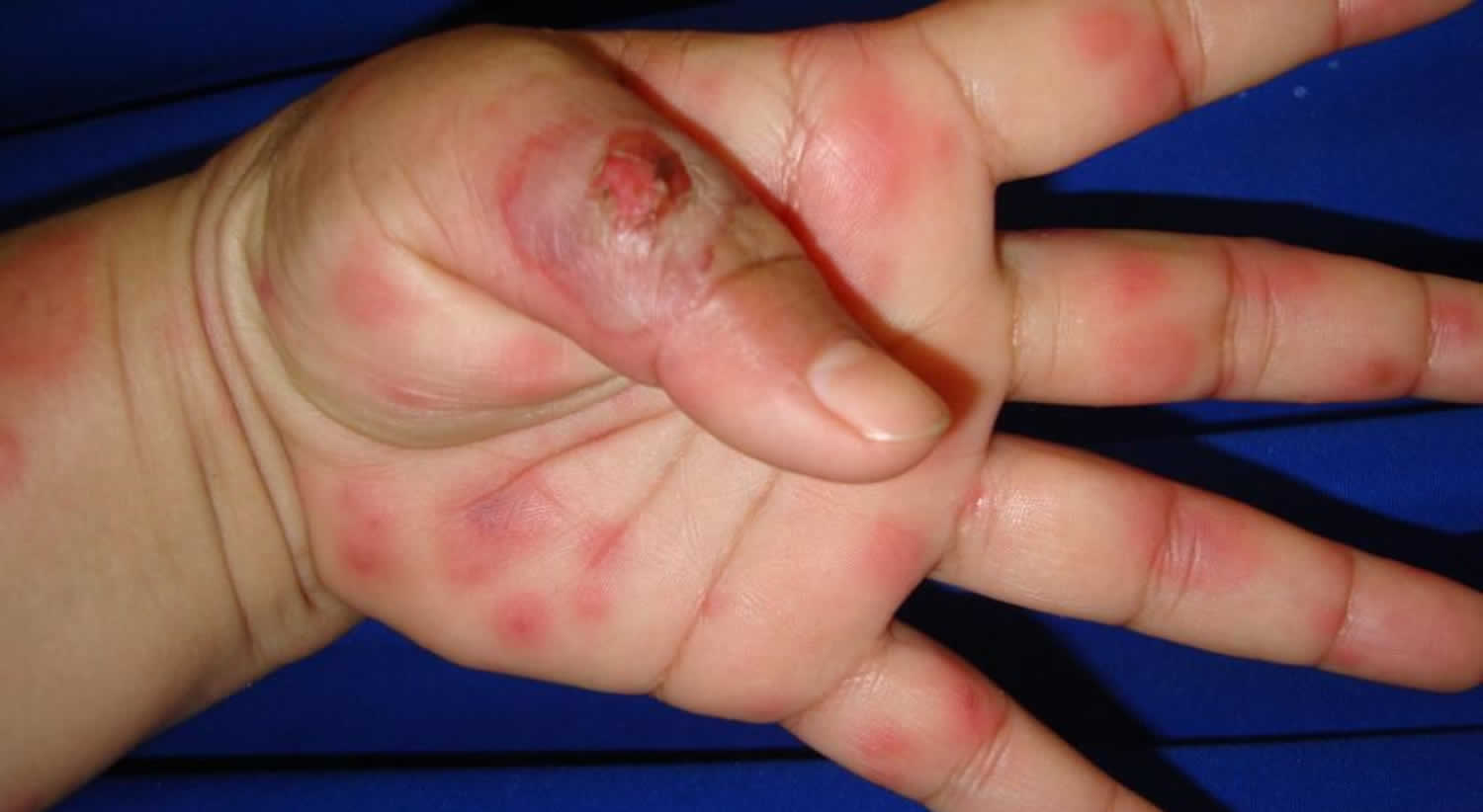 Craniofacial erythema lesbian