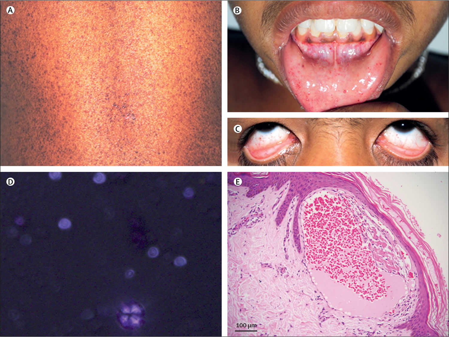 Fabry disease causes, symptoms, life expectancy, diagnosis and treatment