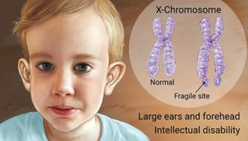 fragile X syndrome