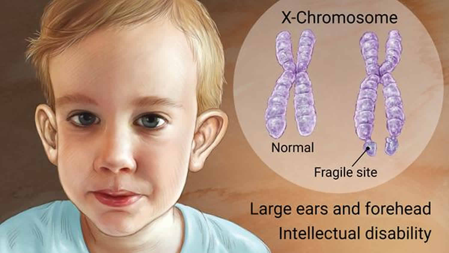 Fragile X Syndrome Causes Inheritance Symptoms Diagnosis And Treatment