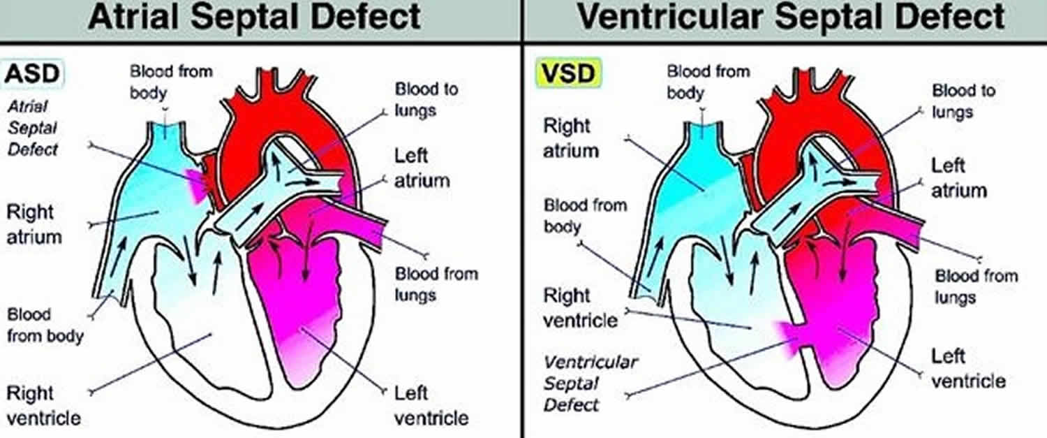 Hole in heart causes, symptoms, prognosis, diagnosis and treatment