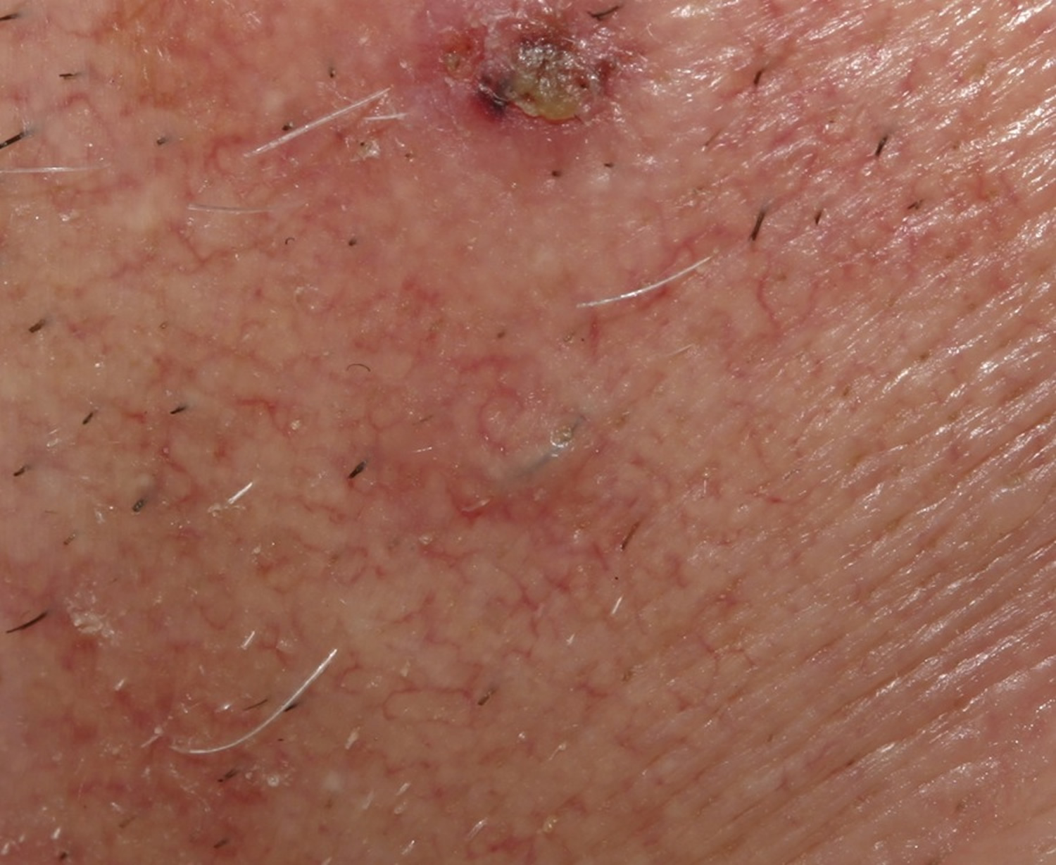 how to get rid of ingrown hair on my leg