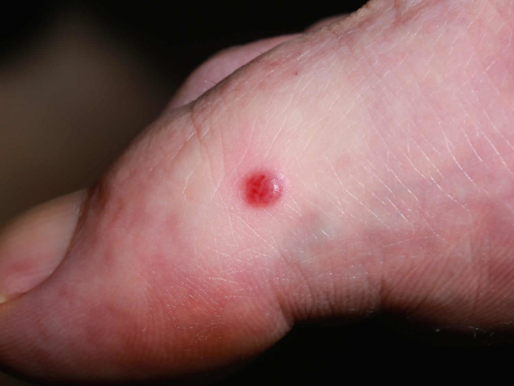 Kaposi causes, symptoms, lesions, prognosis and treatment