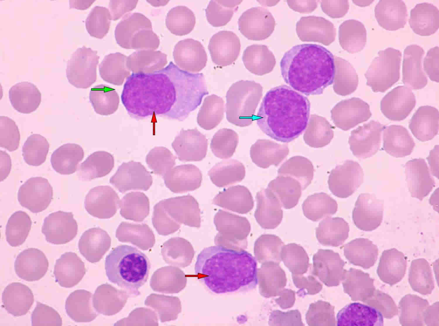 clinical presentation of mantle cell lymphoma