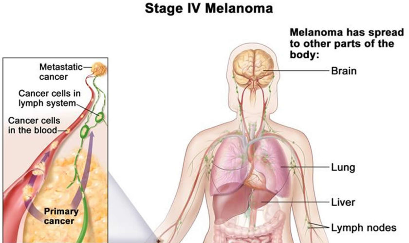 metastatic stage 4 melanoma