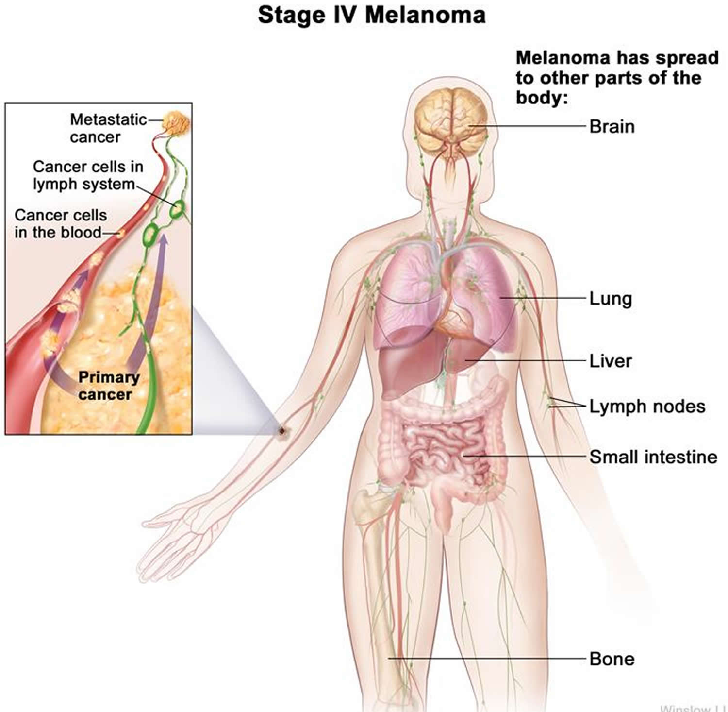 where-prostate-cancer-spreads-in-the-body-affects-survival-time