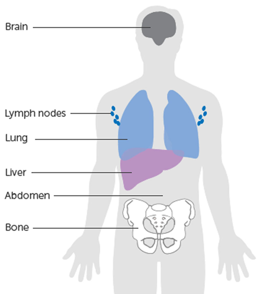 Metastatic stage 4 melanoma, life expectancy & metastatic melanoma ...