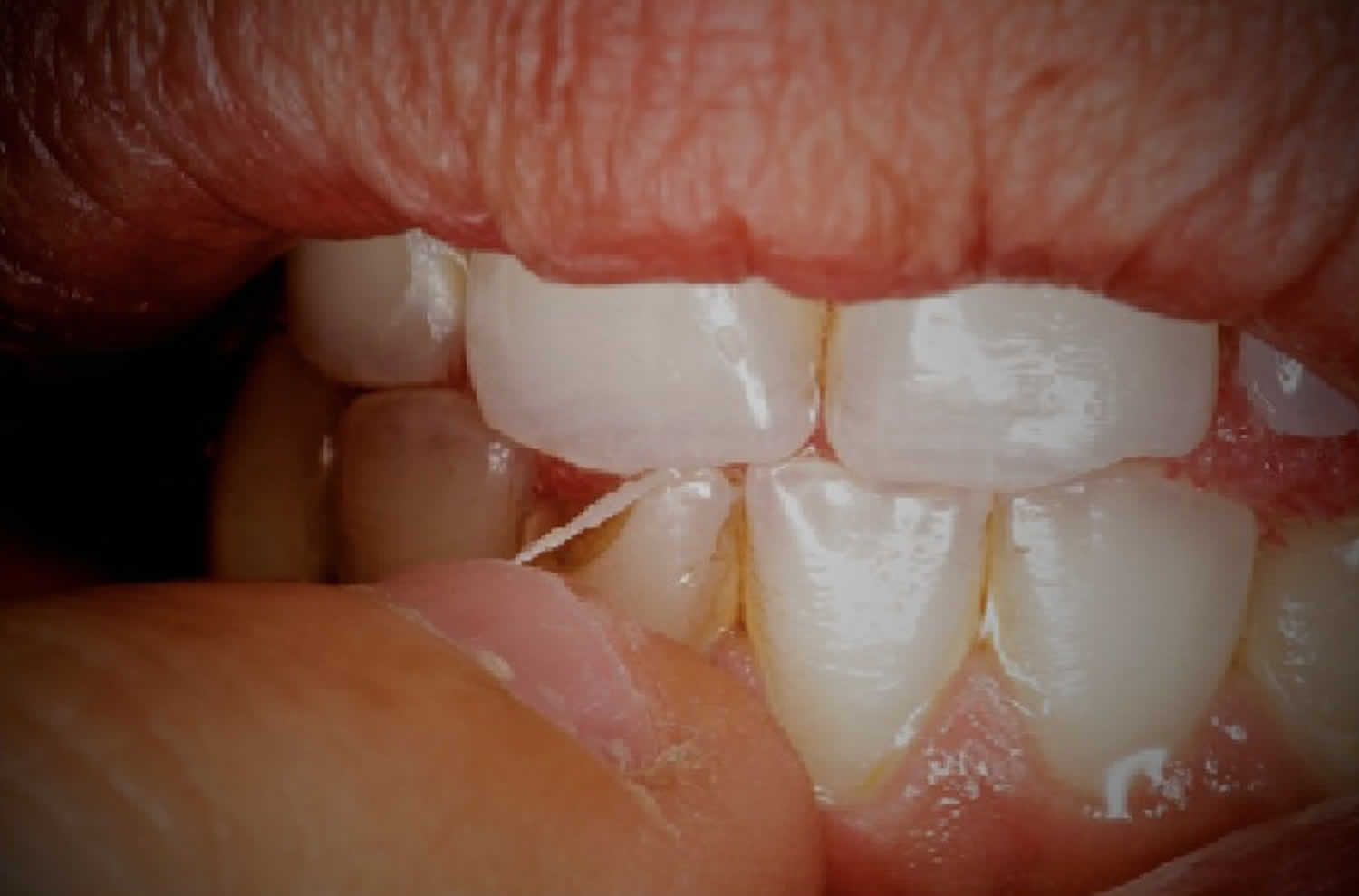 What Nail Biting Can Do to Your Teeth & Gums - Pride Dental