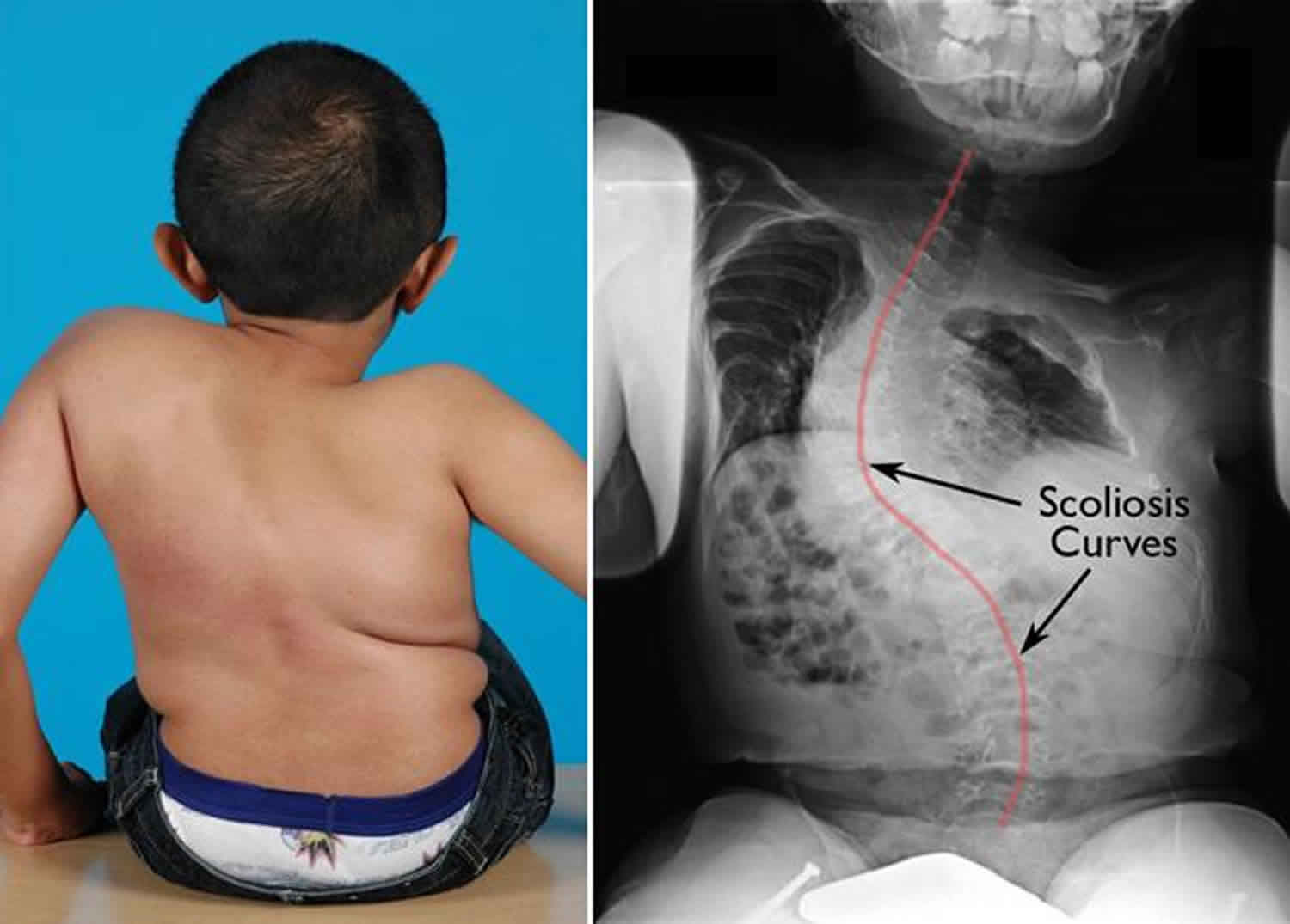 osteogenesis imperfecta type 2 life expectancy