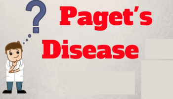 pagets disease