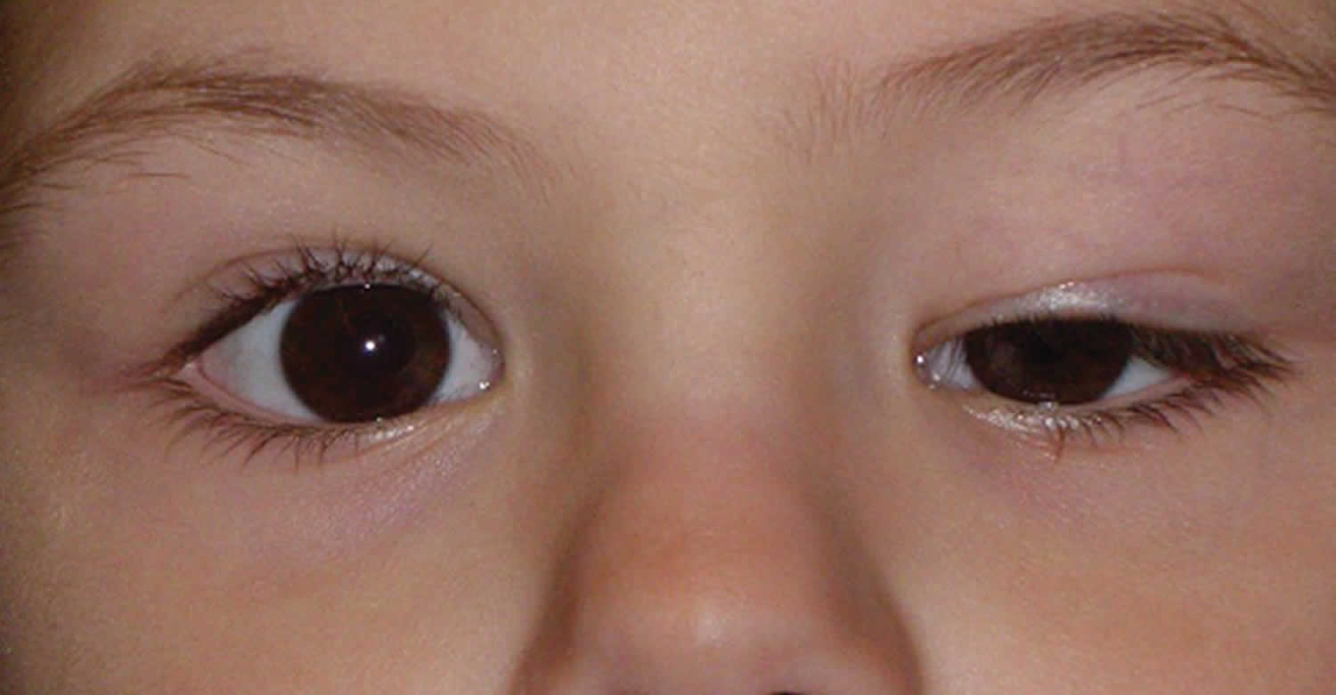 Ptosis Droopy Eyelid Causes Droopy Eyelid Treatment And Ptosis Surgery