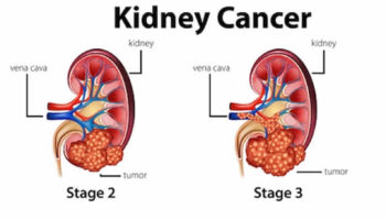 renal cell carcinoma