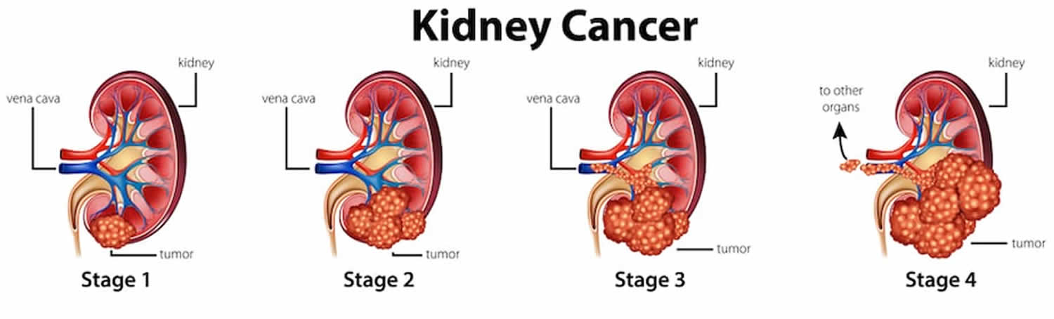 Renal Cell Carcinoma Causes Risk Factors Symptoms Prognosis Treatment