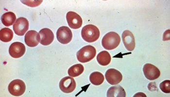 spherocytosis