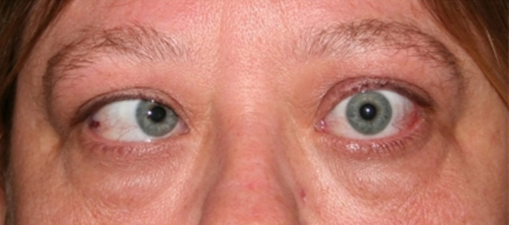 Strabismus Causes Symptoms Diagnosis Strabismus Treatment Surgery