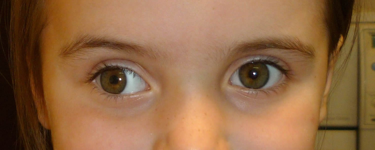 Немного косят глаза. Косоглазие экзотропия. Эзотропия и экзотропия. Расходящееся косоглазие у детей. Косые глаза у детей.