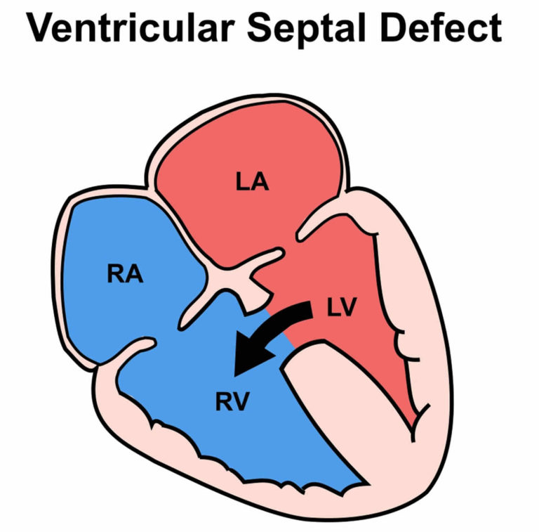 Hole in heart causes, symptoms, prognosis, diagnosis and treatment