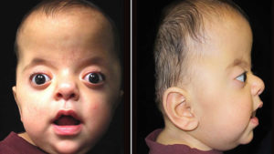 Apert syndrome causes, symptoms, diagnosis & Apert syndrome treatment