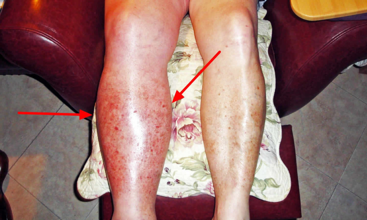 symptoms of a blood clot in the leg