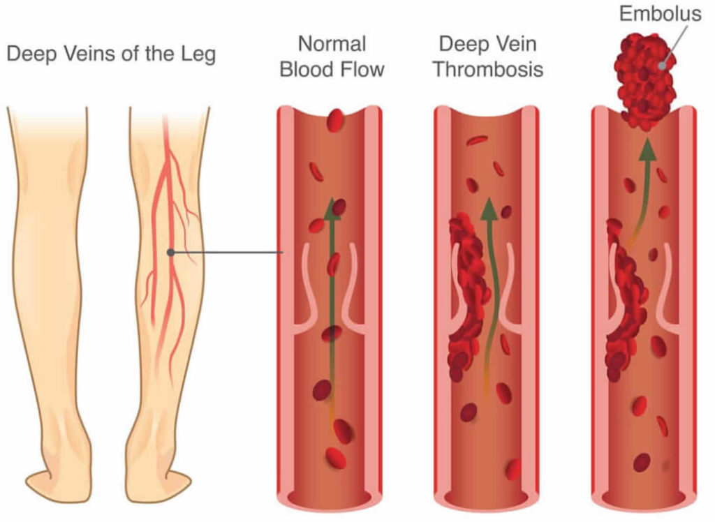 Blood clot causes, symptoms, diagnosis, prevention, prognosis & treatment