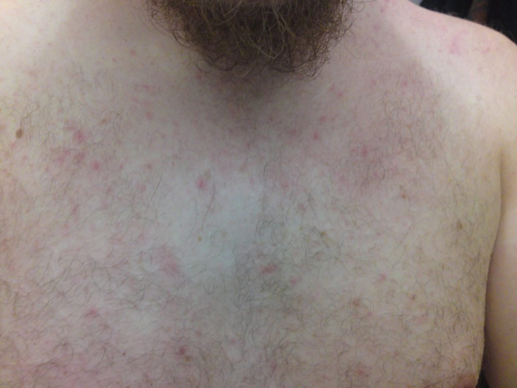 Prickly heat rash, miliaria causes, types, prevention and treatment