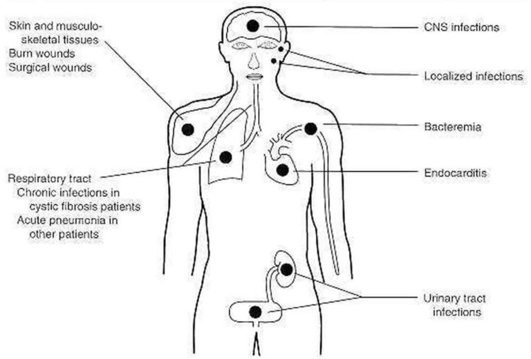 Pseudomonas Pseudomonas Aeruginosa Infections And Treatment   Pseudomonas Aeruginosa Infections 768x520 