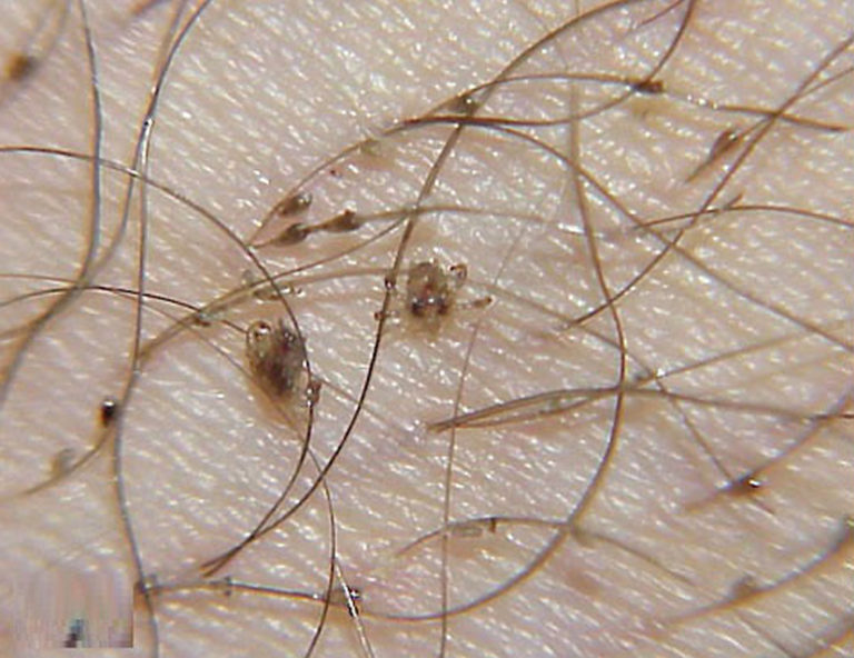 Pubic lice or crab lice signs, symptoms, transmission & pubic lice