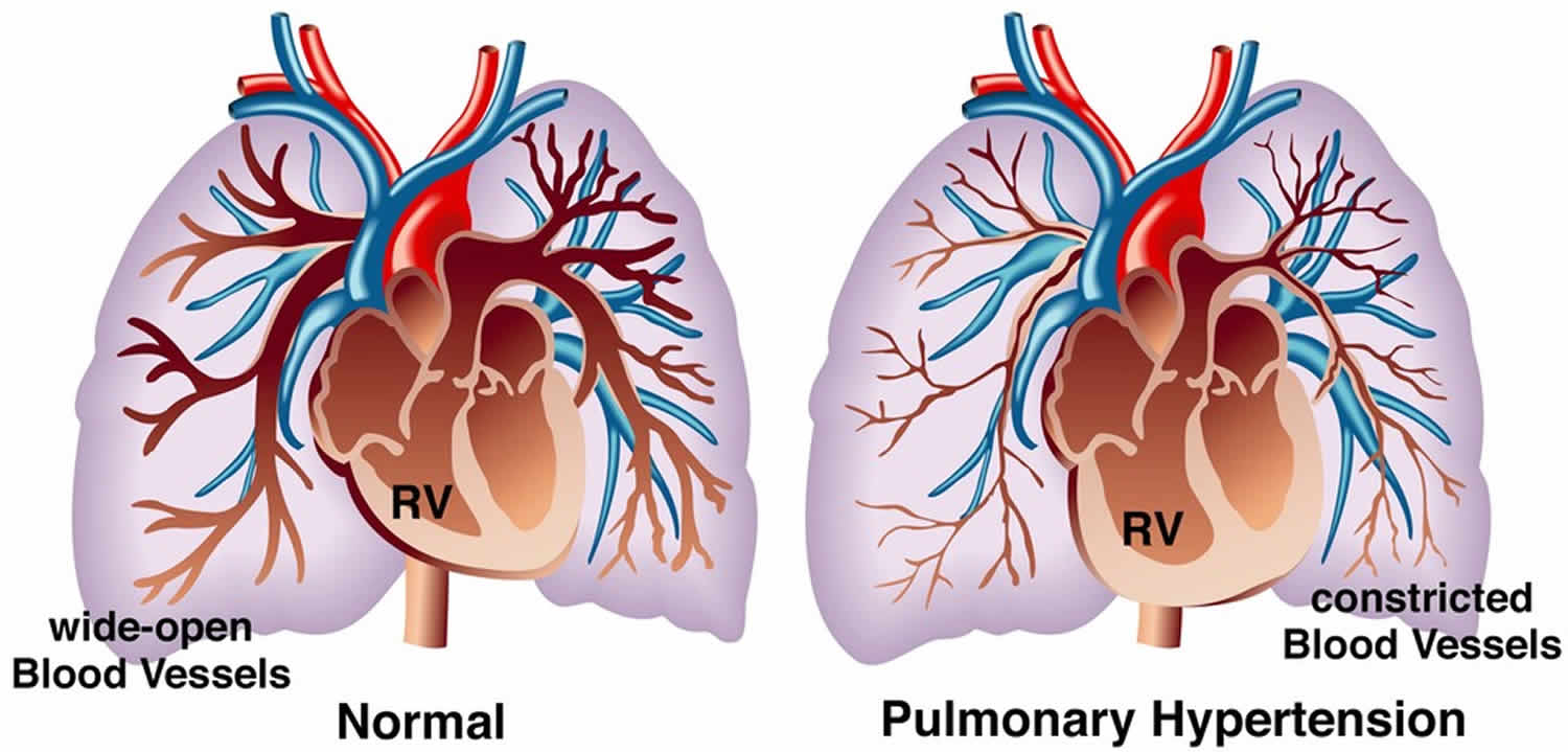 Pulmonary hypertension symptoms