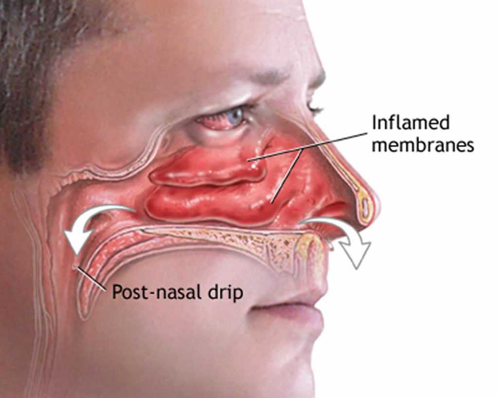 how to unclog nose        <h3 class=