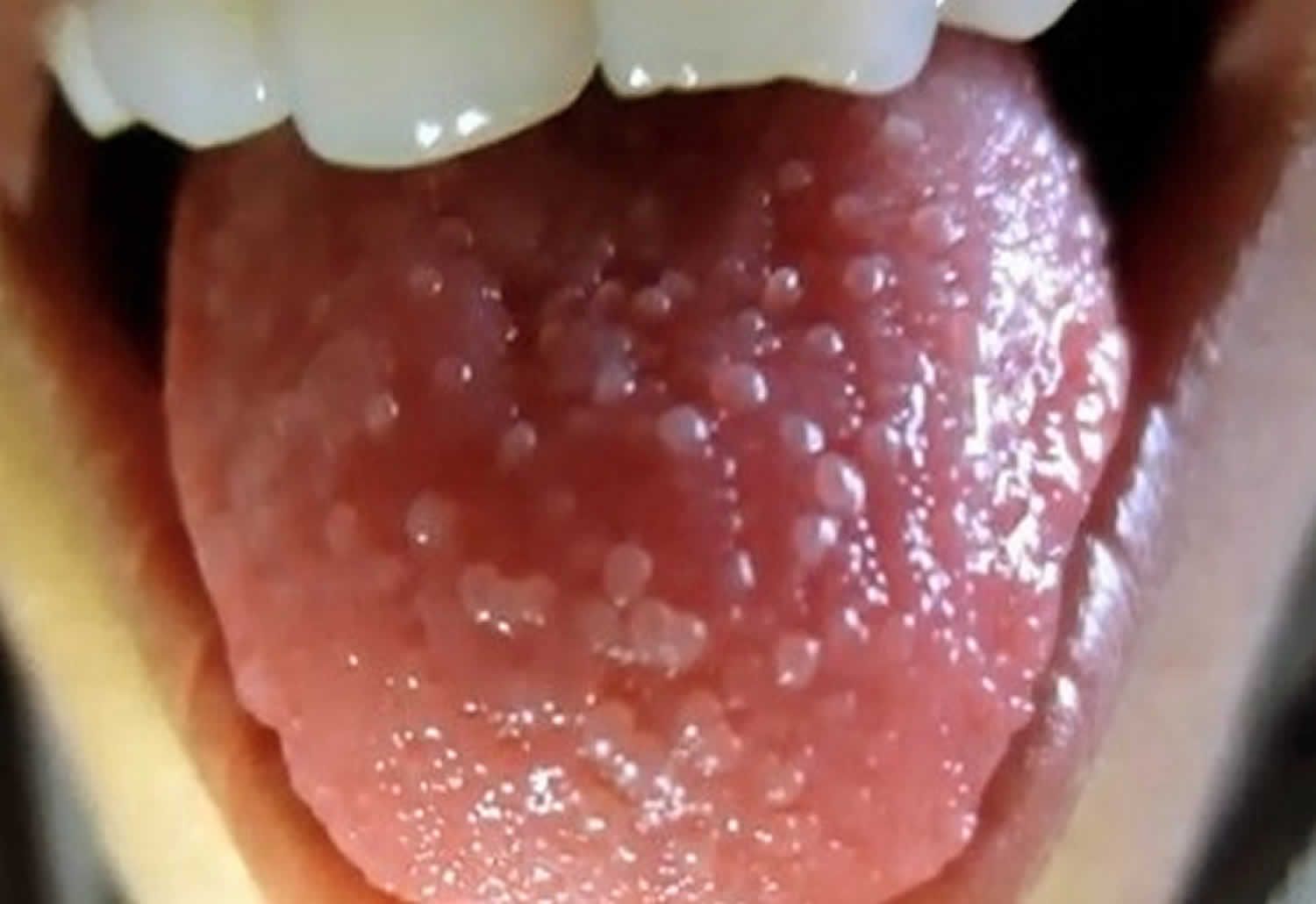 picture-of-bump-on-side-of-tongue-tongue-bumps-on-tongue-tongue