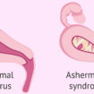 Asherman syndrome