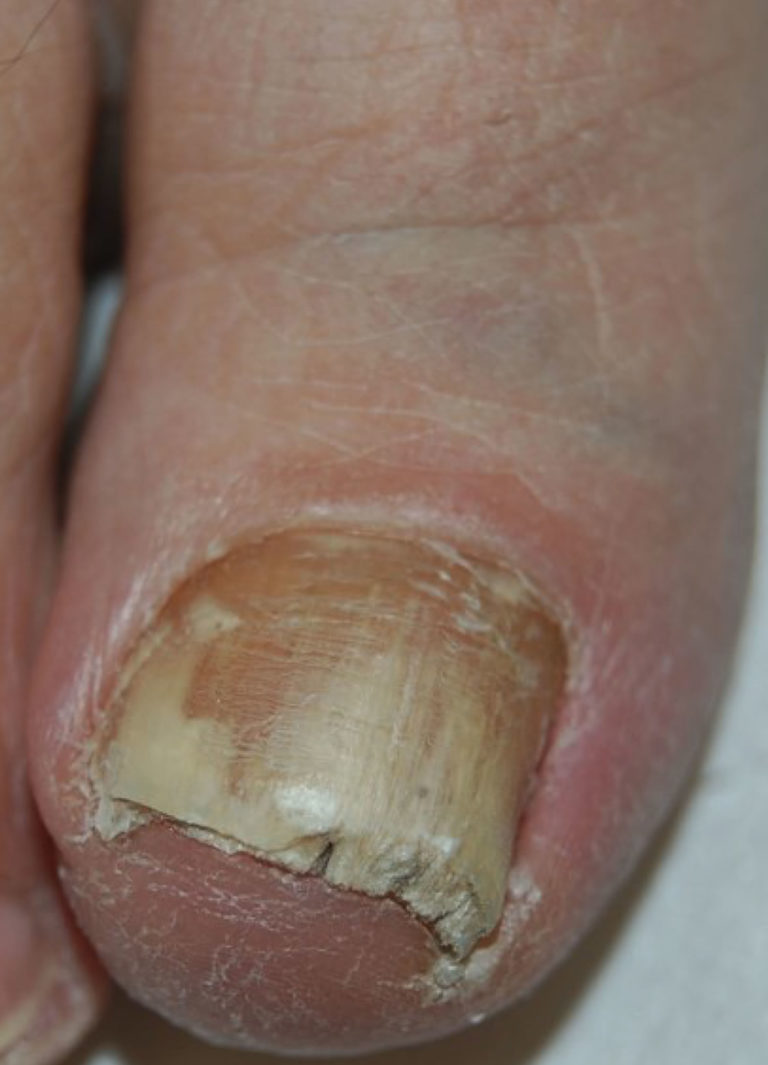 Onychomycosis Causes, Clinical Appearance And Onychomycosis Treatment