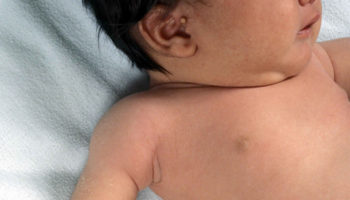 erbs palsy