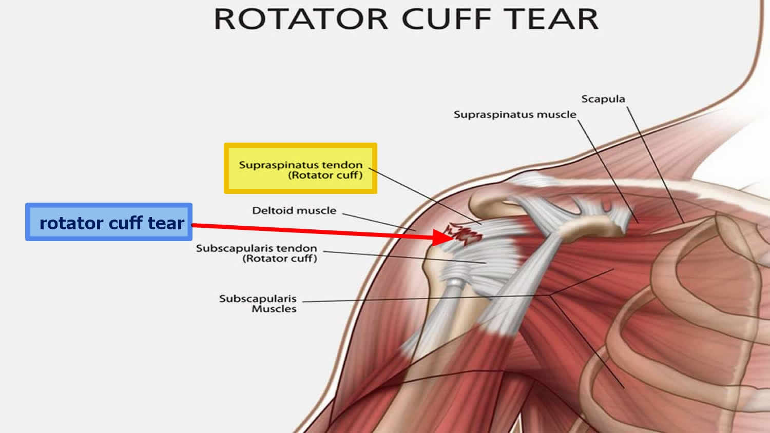 Rotator cuff injury causes, signs, symptoms, diagnosis and treatment