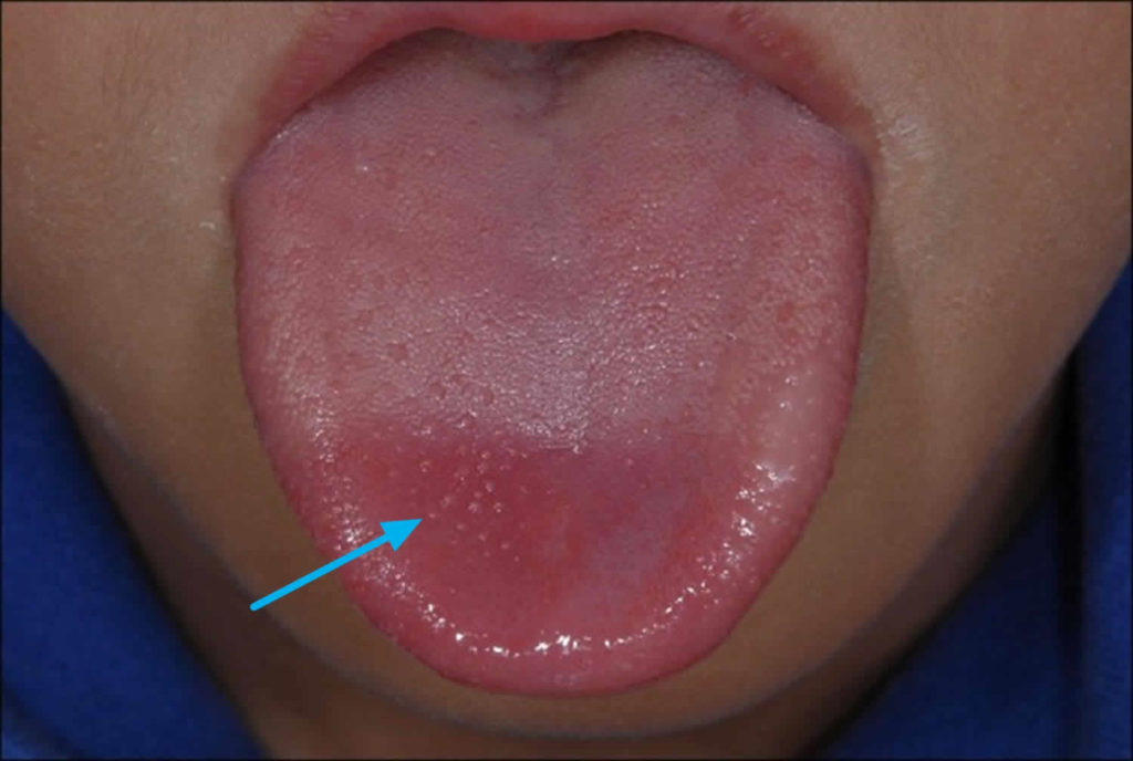 cancer-bumps-on-tongue